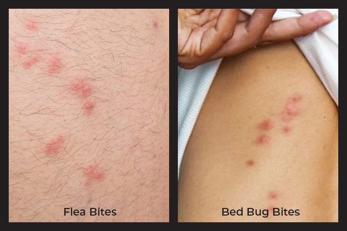 bed bug bites vs flea bites